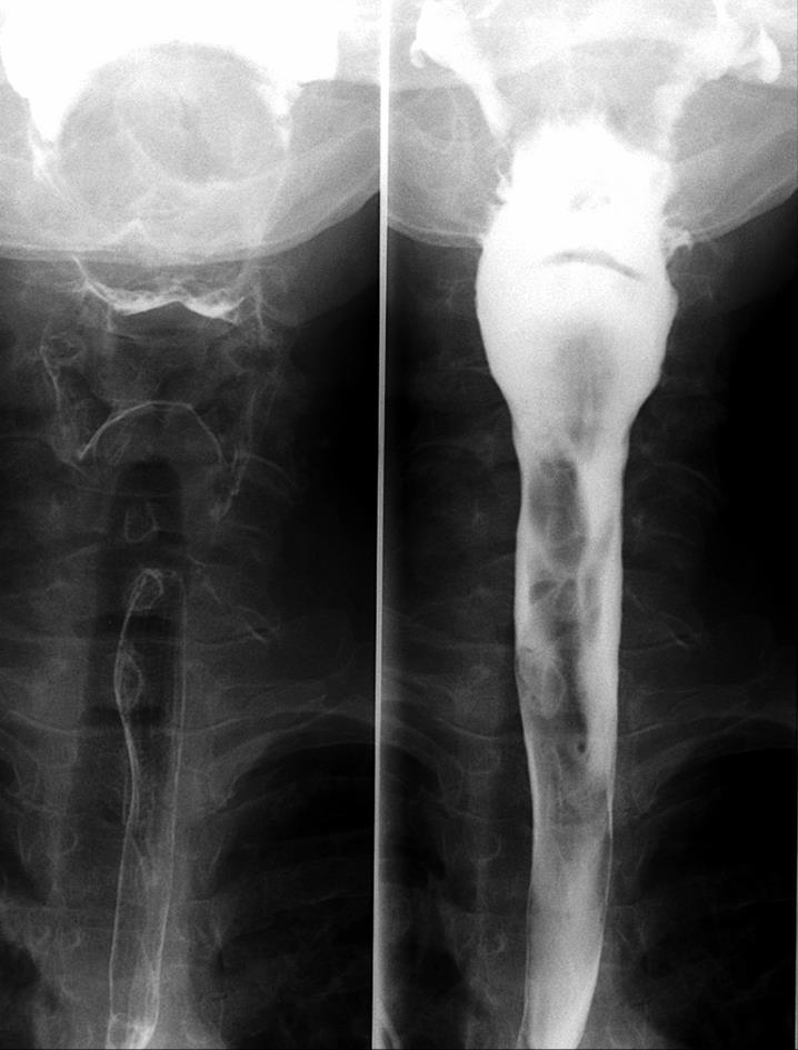 recesus Epiglotis Trachea Jícen