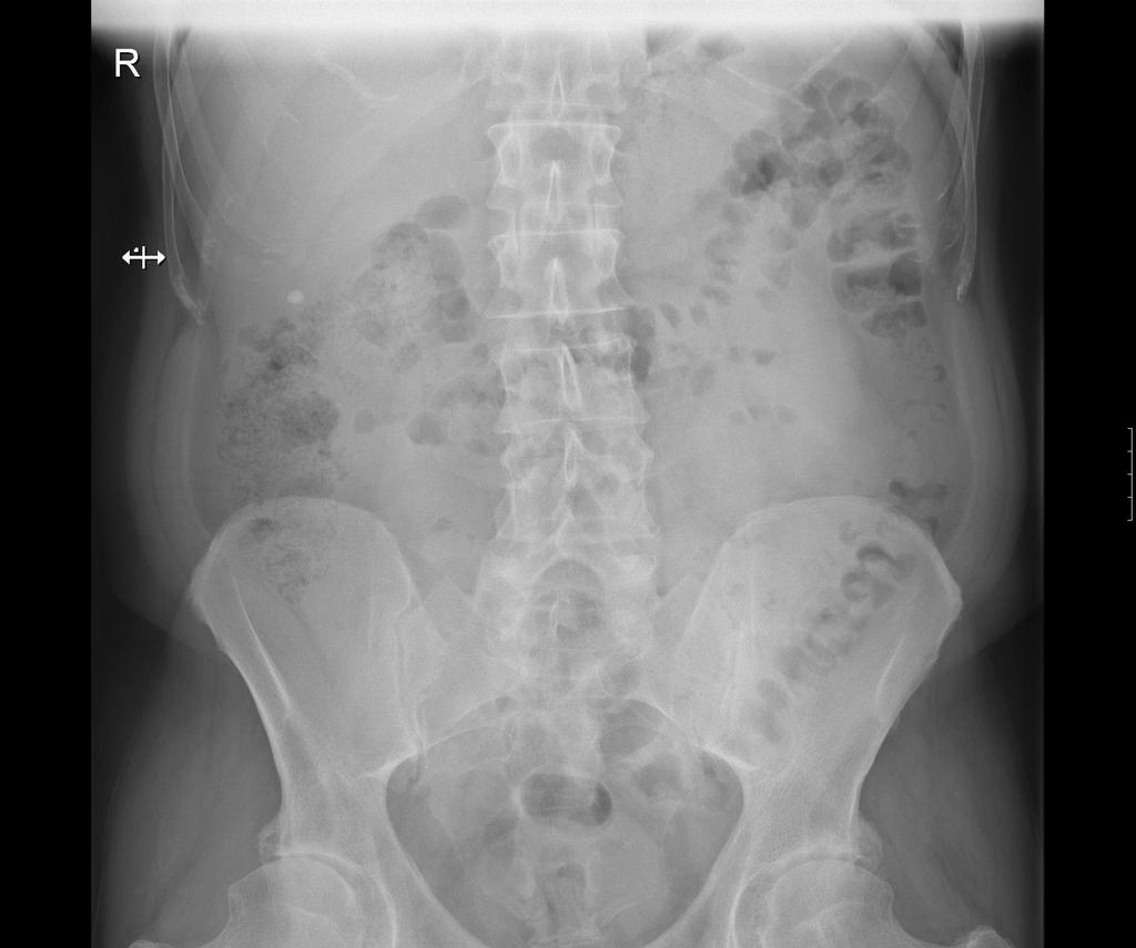 Colon transversum Lienální flexura Dolní roh jater Tři vrstvy svalů