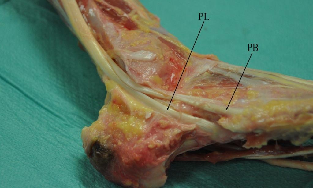 Obrázek 6: Anatomie peroneálních šlach s retinakuly Obrázek 7: Anatomie za zevním kotníkem po odpreparování peroneálních