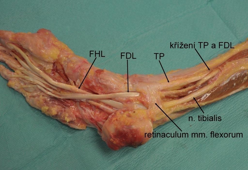 třetině bérce podbíhá TP EDL, a tak se TP dostává nejmediálněji (Obrázek 11). Takto šlachy vstupují za vnitřní kotník, nejmediálněji TP, pak FDL a nejlaterálněji FHL (Obrázek 12).
