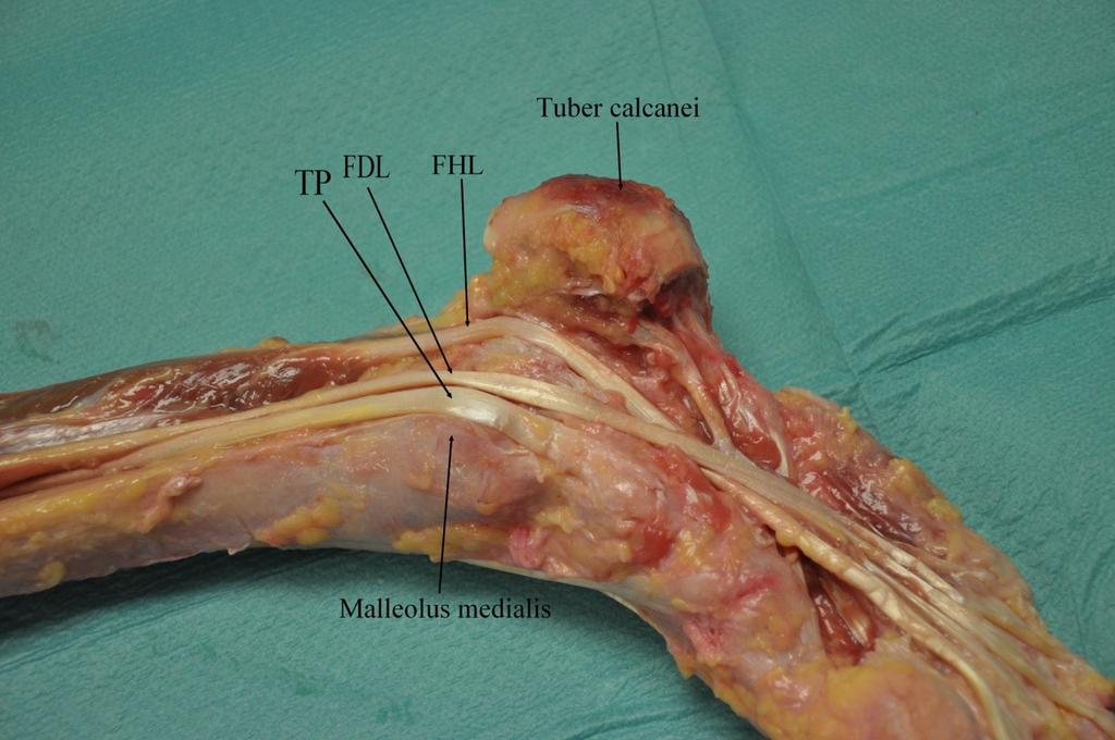 Obrázek 12: Průběh šlach za vnitřním kotníkem. Nejmediálněji probíhá m.