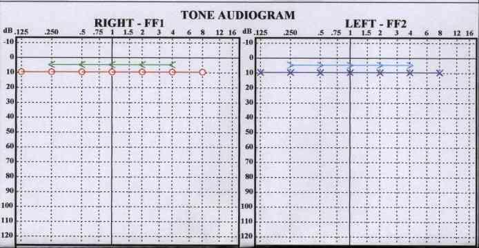 Obrázek 6 Normální audiogram Obrázek 7 Audiogram s převodní nedoslýchavostí typický pro sekretorickou otitidu a její následky 3.1.