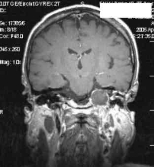 se septikemií, absces epidurální či subdurální s meningitidou anebo absces temporálního laloku či mozečku i parézu lícního nervu.