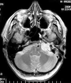 Foto 7 MRI zobrazení cholesteatomu apexu pyramidy jako zdroje opakovaných mengitid a) koronární, b) axiální scan Sumárně je úspěšnost sanace cca 70 %.