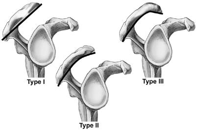pokračováním je další výběžek, acromion, který je běžně hmatatelný a rozděluje se na tři základní typy acromion rovný, oblý a hákovitý.