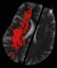 5T MR Vision (2005) and later (2017) 3T MR Trio scanners (A, B). Diffusion data was measured in the same healthy volunteer with the same sequence (6 directions, b-value = 1000 s/mm 2 ).