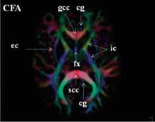 cg cingulum, cc corpus callosum, gcc genu corporis callosi, scc splenium corporis callosi, cc-b truncus corporis callosi, cr corona radiata, slf fasciculus longitudinalis superior, ilf fasciculus