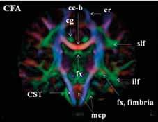 Transversal and coronal slices of a color-coded diffusion maps of fractional anisotropy (CFA) show the bundles of bain white matter (A-C).