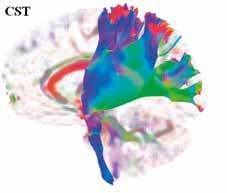 the sagittal diffusion tensor maps of a 30-year-old healthy woman.