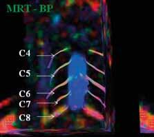 MR tractography of the normal brachial plexus of a 30-year-old healhty volunteer is