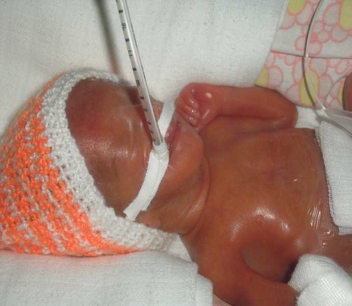 Apnoe mechanizmus vzniku III. Úloha neurotransmitrov a apnea Zvýšiná citlivosť na inhibičné neurotransmitery: gammaaminobutárová kys.
