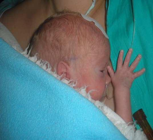Apnoe intervencie Kangaroo mother care klokankovanie skin-to-skin. Kontraverzné názory ukľudňuje Stabilizuje vitálne funkcie Apnoe a bradykardie sú častejšie počas kangaroo care???. Bohnhorst B, et al.