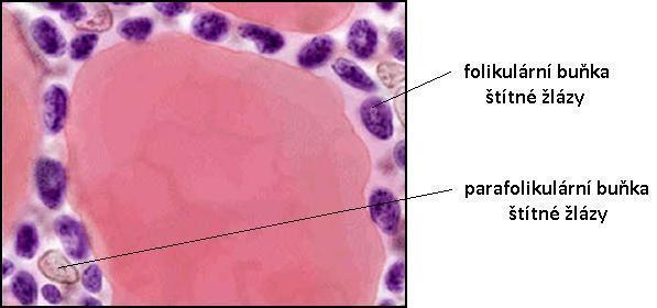 Obr. 8 Buňky štítné žlázy 1.3.3 Klinické rysy MTC MTC představuje 8 % všech karcinomů štítné žlázy. Je tvořen vřetenovitými či polygonálními buňkami s nepravidelnou trámčinou.