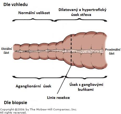 1.4.3 Symptomy HSCR Absence gangliových buněk v daném úseku střeva způsobí jeho zúžení a ztrátu motility, které brání vyprázdnění úseku nad ním, střevo zde pak dilatuje, tvoří megakolon a dochází k