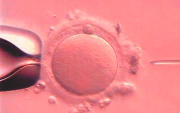 In vitro fertilizace a embryotransfer: indikuje se v případech endometriózy, andrologického faktoru, imunologické příĉiny neplodnosti, ovariálního faktoru, genetických příĉin s indikací PGD/PGS, při