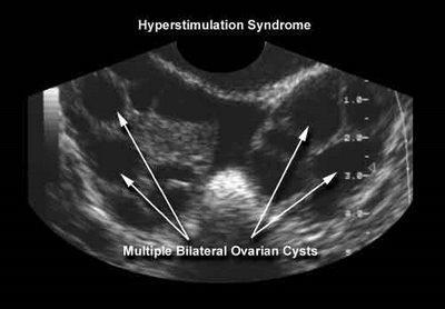 Poměrně novým onemocněním souvisejícím se stimulací ovarií je ovariální hyperstimulaĉní syndrom (OHSS).
