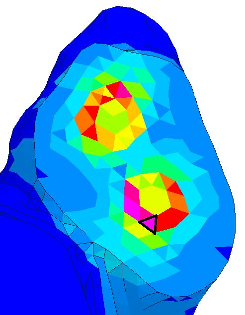 Obr. 5.2.3.1-4 Laterální projekce pohled na laterální plochu transforaminální linie (vizualizovaná jen levá hemipelvis laterálně od zlomeniny), obr.