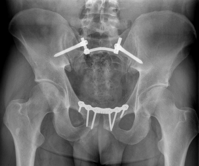 Obr. 1c Obr. 1 29letý pacient po nehodě na čtyřkolce, 61-C1.2, SI dislokace vlevo (na axiálním CT skenu zadního segmentu obr.