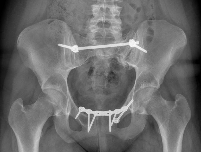 Obr. 2c Obr. 2 15letá pacientka utrpěla poranění 61-C1.3, Pohlemann I při autonehodě (spolujezdkyně), na axiálním CT patrná kominutivní transalární zlomenina kosti křížové vlevo (obr.