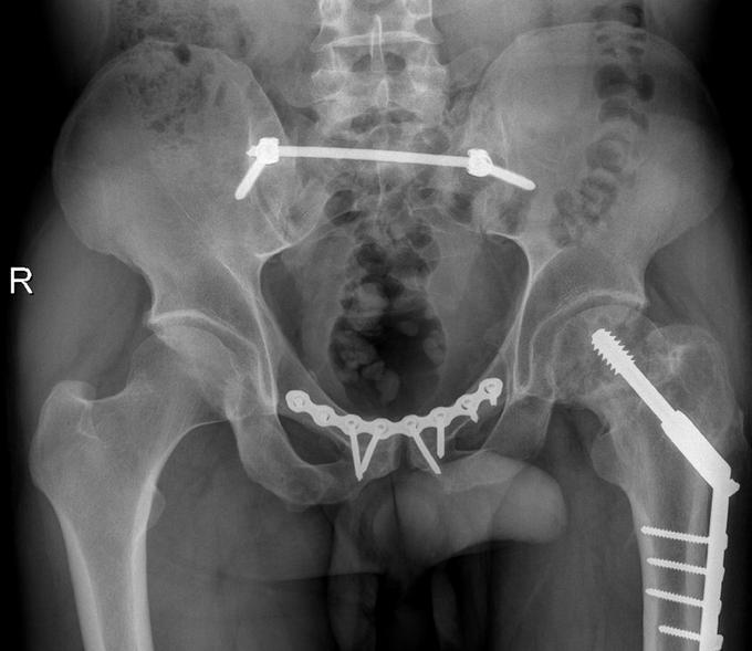 Obr. 3c Obr. 3 Pacient po pádu z výše, poranění C1.3, Pohlemann II, na axiálním CT patrná transforaminální zlomenina vlevo (obr. 3a).