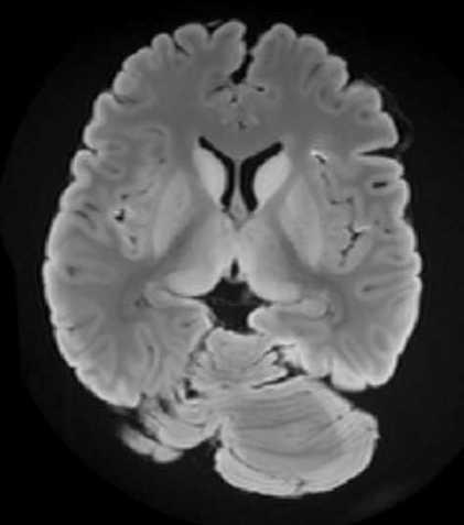 Ncl. caudatus Corpus callosum Crus anterius Putamen Genu Crus