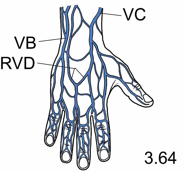 Veins of upper limb VS subclavian vein VA axillary vein VBR brachial veins VC cephalic vein VB basilic vein VMC median cubital vein VMA median antebrachial vein VCA