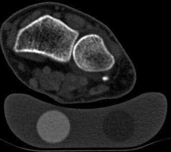 Metodologie vantitativní počítačová tomografie (QCT) distálního rádia KH fáze 3