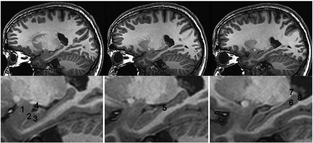 1=amygdala, 2=alveus, 3=hippocampal head, 4=temporal horn of the lateral ventricle and fimbria, 5=hippocampal body, 6=hippocampal tail, 7=fimbria, 8=alveus.