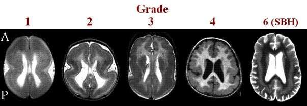 Syndrom Miller-Dieker Miller-Dieker lissencephaly syndrome mikrocefalie růstová retardace srdeční malformace mentální