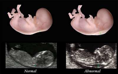 Turnerův syndrom Prenatálně 1:2000-5000 zvýšené šíjové projasnění koarktace aorty hypoplázie levého srdce