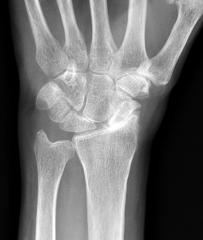 191/ Acta Chir Orthop Traumatol Cech. 84, 2017, No. 3 PŮVODNÍ PRÁCE Obr. 1. Rentgenový snímek u pacienta s těžkým postižením karpu, které odpovídá SLAC III. stupně. Obr. 2. Peroperační snímek, který zachycuje připravené lůžko pro dlahu, je patrna dobrá kongruence dézovaných kostí karpu.