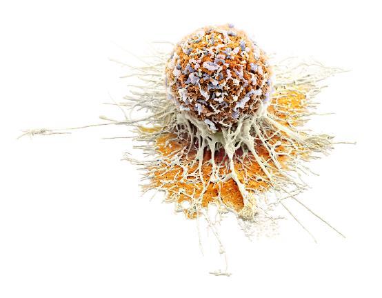 Mechanism of fludarabine resistance in Mantle cell