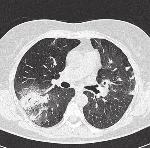 trakční bronchiektázie, absence voštiny; nález byl ověřen histologicky  4: Kryptogenní organizující se pneumonie (COP) oboustranné subpleurální a