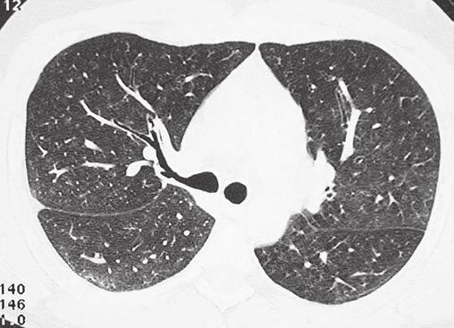 organizující se pneumonie nebo exogenní alergická alveolitida, UIP lze vyloučit  5: Respirační bronchiolitida intersticiální plicní nemoc (RB ILD) denzity