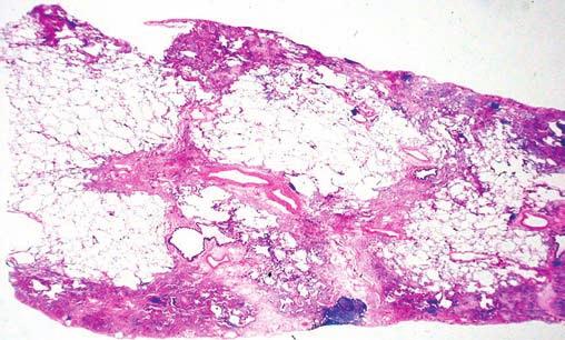 V klinické praxi u většiny nemocných s intersticiálním plicním onemocněním nemusí dojít z různých důvodů k bioptickému odběru, ale jednoznačné určení diagnózy je možné pouze na podkladě