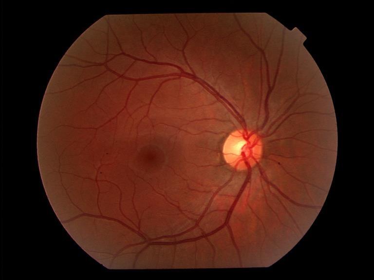 Vyšetření oka a okolních tkání Vzhled sítnice 15 (~ 4 mm) Exkavace (případně s nablednutím) Macula lutea Papila (slepá
