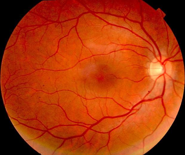 Vyšetření oka a okolních tkání Zadní segment Záznam nákres fotografie 13.