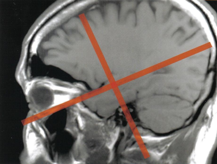 Příloha č. 5: MR mozku: Orientace šikmé koronární roviny kolmo k dlouhé ose hippokampu, roviny pouţívané k zobrazení meziálního kortexu.
