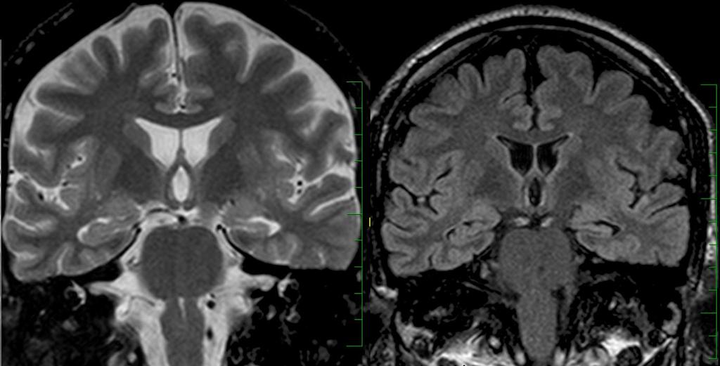 Příloha č. 6: MR mozku: Obraz MTS - signálové změny vlevo, levý hippokampus je zmenšen.