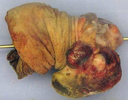 performed. Histopatological examination revealed uncommon diagnosis of plasmablastic lymphoma involving glans penis and prepuce.