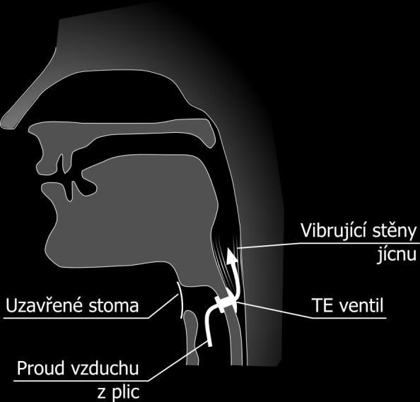 jednocestnost tohoto hlasotvorného ventilu, aby nedocházelo k inspiracím potravy a slin. Ventil je konstrukčně proveden tak, že při průchodu vzduchu tvoří zdrojový hlas.