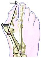 hallux valgus je 40 a pro intermetatarsální 1-2 úhel 16 (Glasoe et al., 2010). Fyziologické hodnoty pro HVA jsou <15 a pro IMA <9 (Hart et al., 2008). Obr.