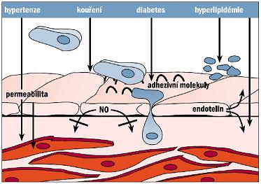 Obr. 1 Poškození endoteliální funkce hlavními rizikovými faktory aterosklerózy (23). 2.