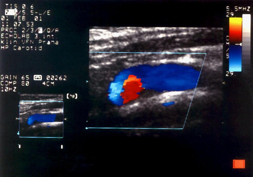 WSS a ateroskleróza Ultrasonografie s barevným doppler.