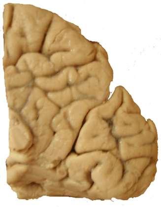 Primární a sekundární zrakové oblasti V1=17 kolem fissura calcarina V2=18, 19 Granulární kůra, retinotopické uspořádání Leze V1 korová slepota vypadnou kontralat zorná pole Leze V2 vizuální agnosie