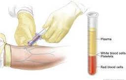 Přehled nejčast astěji zpracovávaných vaných vzorků tělní tekutiny - 1 Periferní krev vkládá se do izolace NK přímo Je homogenní, ale obsah buněčných frakcí je variabilní V krvi lze NK inf.