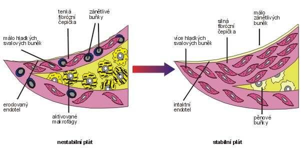 Aterosklerotický plát V druhé fází se z lipidních proužku postupně vyvíjí fibrózní plát. Ateroslerotický neboli fibrózní plát obsahuje jádro, které je složeno z lipidních nebo nekrotických částí.