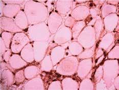 I po vysazení statinů progrese slabosti (CK 79 µkat/l). Ve svalové biopsii je v barvení hematoxylinem-eozinem (A) obraz nekrotizující myopatie bez přítomnosti zánětlivého infiltrátu.