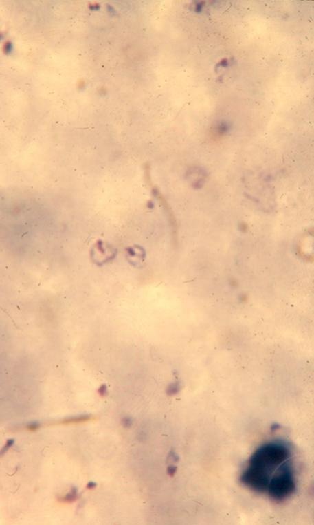 druhu plasmodia Stanovení parazitémie Citlivost 50