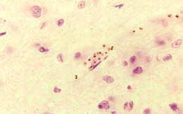 Komplikace tropické malárie Cerebrální malárie Renální selhání Plicní edém (ARDS) Laktátová acidóza Krvácivé